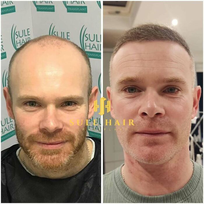 Surgeons Show What A Hair Transplant Can Do With 81 Before And After Pics Surgeons Show What A Hair Transplant Can Do With 81 Before And After Pics
