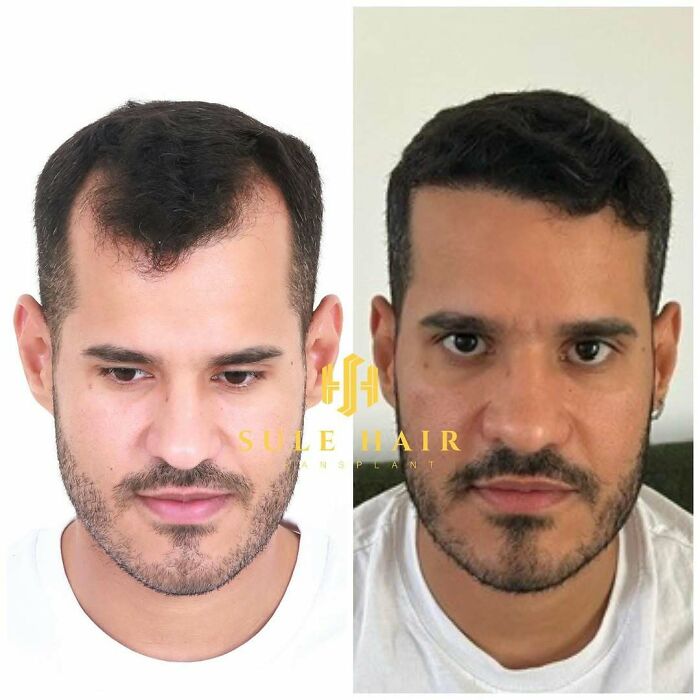 Surgeons Show What A Hair Transplant Can Do With 81 Before And After Pics Surgeons Show What A Hair Transplant Can Do With 81 Before And After Pics
