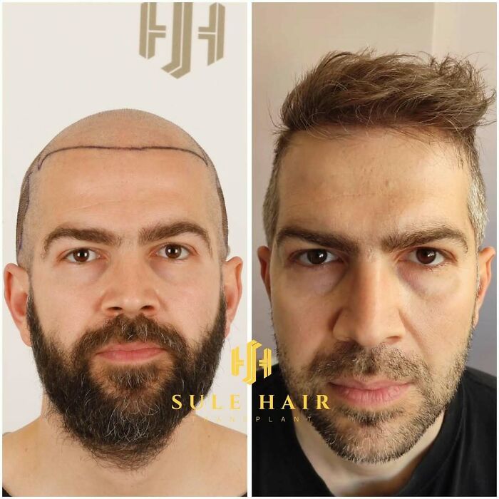 Surgeons Show What A Hair Transplant Can Do With 81 Before And After Pics Surgeons Show What A Hair Transplant Can Do With 81 Before And After Pics