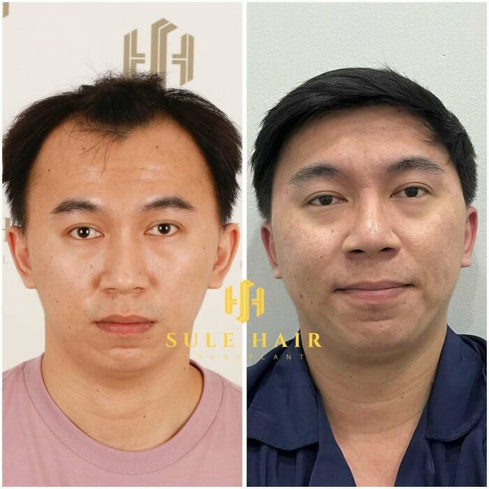 Surgeons Show What A Hair Transplant Can Do With 81 Before And After Pics Surgeons Show What A Hair Transplant Can Do With 81 Before And After Pics