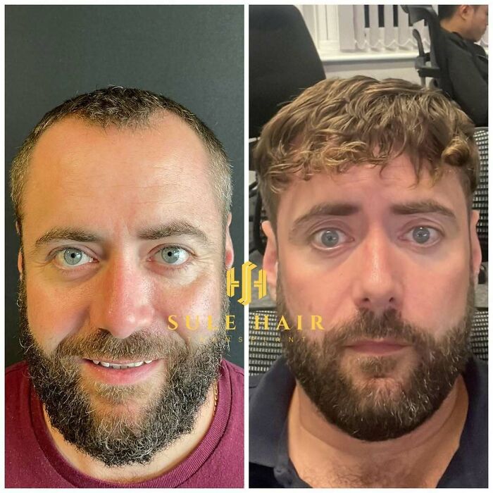 Surgeons Show What A Hair Transplant Can Do With 81 Before And After Pics Surgeons Show What A Hair Transplant Can Do With 81 Before And After Pics