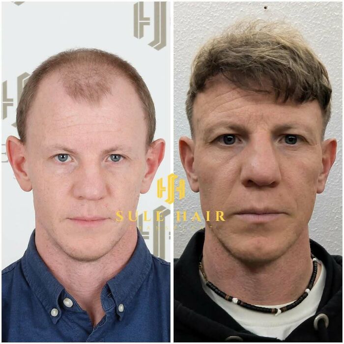 Surgeons Show What A Hair Transplant Can Do With 81 Before And After Pics Surgeons Show What A Hair Transplant Can Do With 81 Before And After Pics