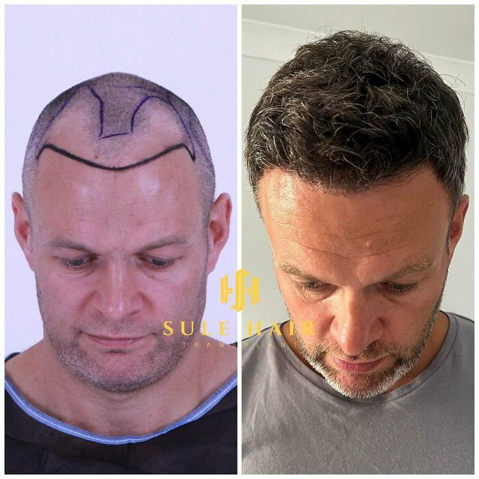 Surgeons Show What A Hair Transplant Can Do With 81 Before And After Pics Surgeons Show What A Hair Transplant Can Do With 81 Before And After Pics