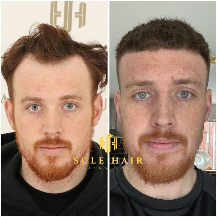 Surgeons Show What A Hair Transplant Can Do With 81 Before And After Pics Surgeons Show What A Hair Transplant Can Do With 81 Before And After Pics