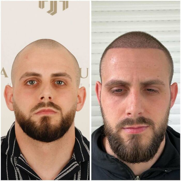 Surgeons Show What A Hair Transplant Can Do With 81 Before And After Pics Surgeons Show What A Hair Transplant Can Do With 81 Before And After Pics