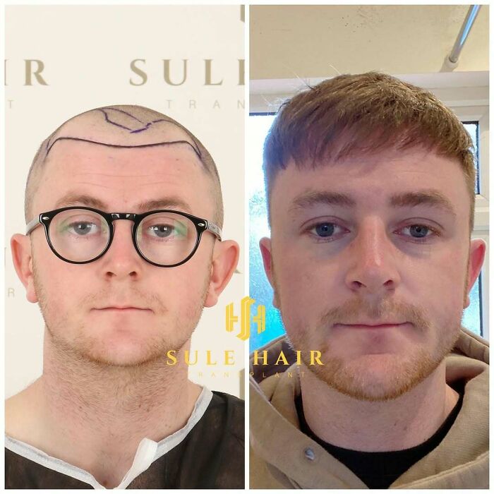 Surgeons Show What A Hair Transplant Can Do With 81 Before And After Pics Surgeons Show What A Hair Transplant Can Do With 81 Before And After Pics