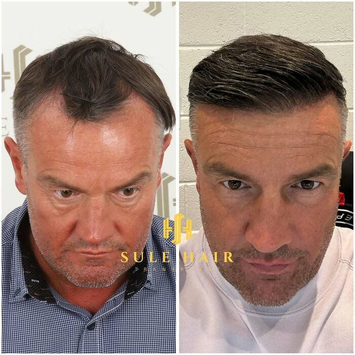 Surgeons Show What A Hair Transplant Can Do With 81 Before And After Pics Surgeons Show What A Hair Transplant Can Do With 81 Before And After Pics