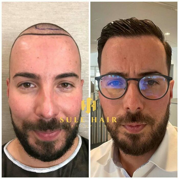 Surgeons Show What A Hair Transplant Can Do With 81 Before And After Pics Surgeons Show What A Hair Transplant Can Do With 81 Before And After Pics
