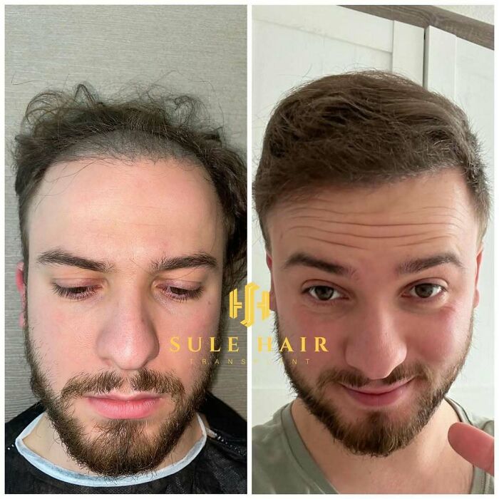 Surgeons Show What A Hair Transplant Can Do With 81 Before And After Pics Surgeons Show What A Hair Transplant Can Do With 81 Before And After Pics