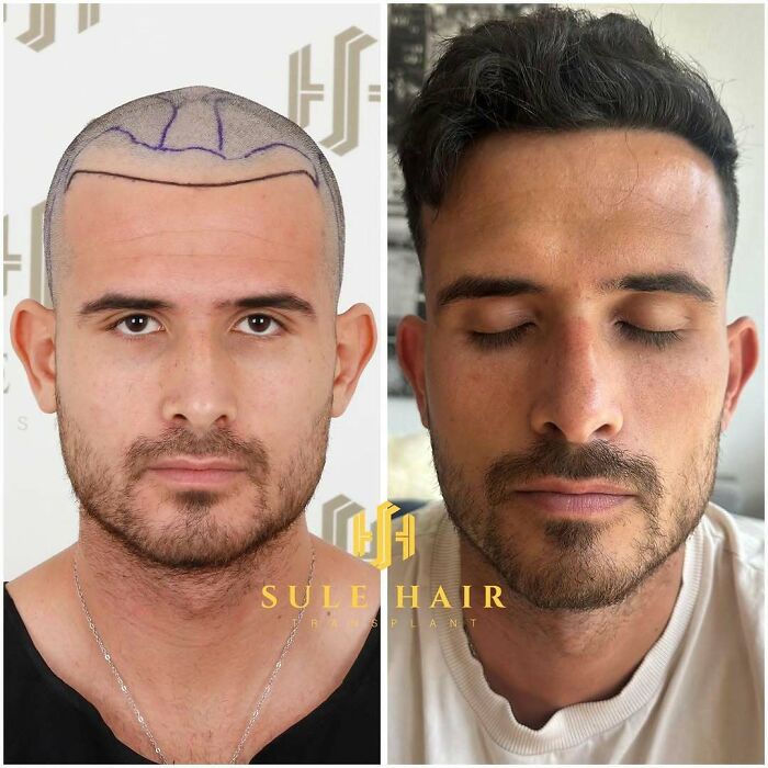 Surgeons Show What A Hair Transplant Can Do With 81 Before And After Pics Surgeons Show What A Hair Transplant Can Do With 81 Before And After Pics