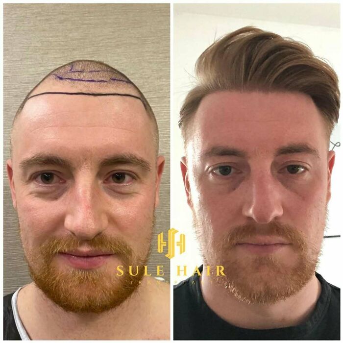 Surgeons Show What A Hair Transplant Can Do With 81 Before And After Pics Surgeons Show What A Hair Transplant Can Do With 81 Before And After Pics