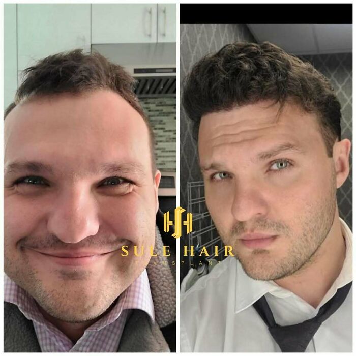 Surgeons Show What A Hair Transplant Can Do With 81 Before And After Pics Surgeons Show What A Hair Transplant Can Do With 81 Before And After Pics