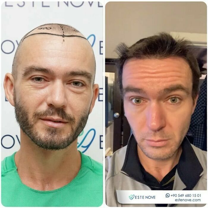 Surgeons Show What A Hair Transplant Can Do With 81 Before And After Pics Surgeons Show What A Hair Transplant Can Do With 81 Before And After Pics