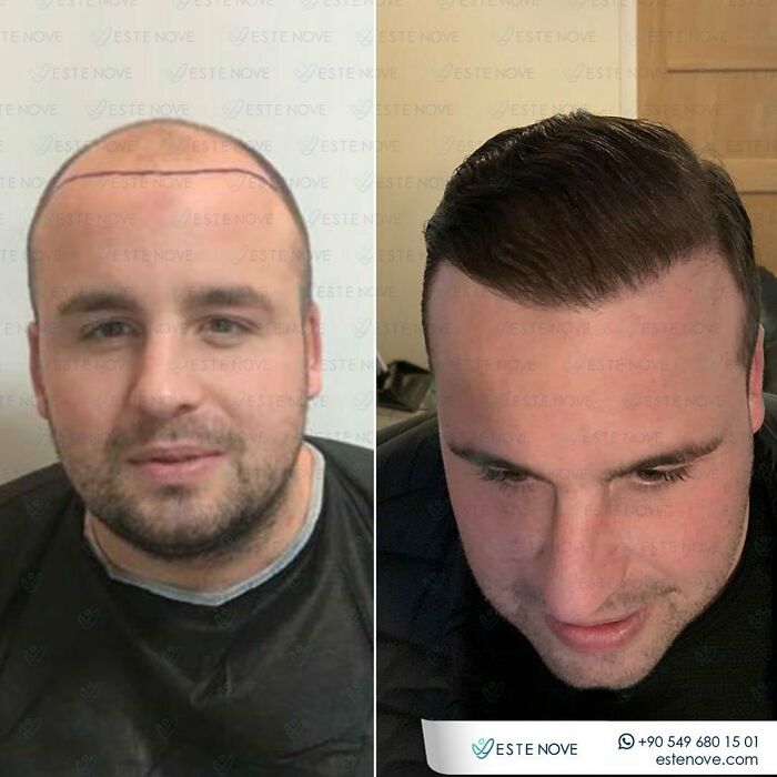 Surgeons Show What A Hair Transplant Can Do With 81 Before And After Pics Surgeons Show What A Hair Transplant Can Do With 81 Before And After Pics