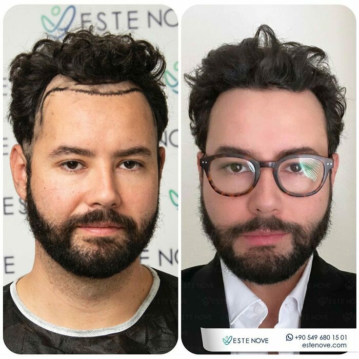 Surgeons Show What A Hair Transplant Can Do With 81 Before And After Pics Surgeons Show What A Hair Transplant Can Do With 81 Before And After Pics