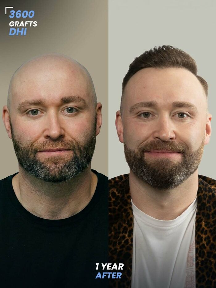 Surgeons Show What A Hair Transplant Can Do With 81 Before And After Pics Surgeons Show What A Hair Transplant Can Do With 81 Before And After Pics