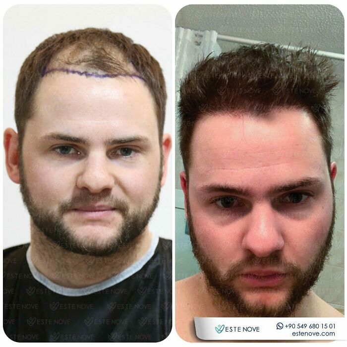 Surgeons Show What A Hair Transplant Can Do With 81 Before And After Pics Surgeons Show What A Hair Transplant Can Do With 81 Before And After Pics