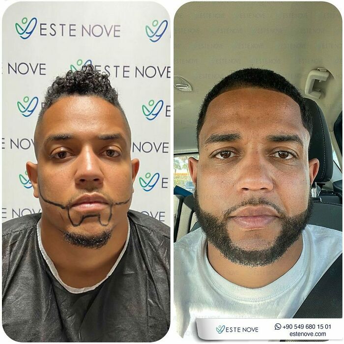 Surgeons Show What A Hair Transplant Can Do With 81 Before And After Pics Surgeons Show What A Hair Transplant Can Do With 81 Before And After Pics