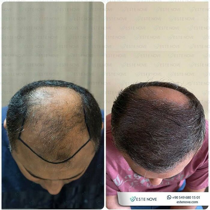 Surgeons Show What A Hair Transplant Can Do With 81 Before And After Pics Surgeons Show What A Hair Transplant Can Do With 81 Before And After Pics