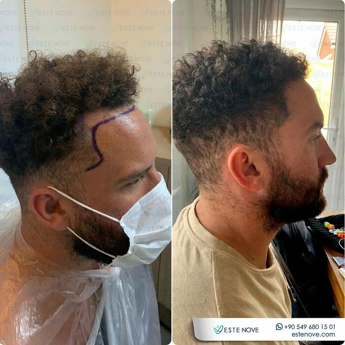 Surgeons Show What A Hair Transplant Can Do With 81 Before And After Pics Surgeons Show What A Hair Transplant Can Do With 81 Before And After Pics