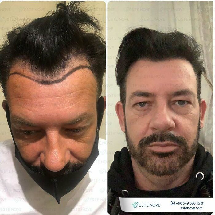 Surgeons Show What A Hair Transplant Can Do With 81 Before And After Pics Surgeons Show What A Hair Transplant Can Do With 81 Before And After Pics