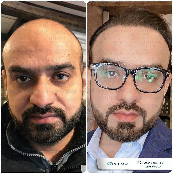 Surgeons Show What A Hair Transplant Can Do With 81 Before And After Pics Surgeons Show What A Hair Transplant Can Do With 81 Before And After Pics