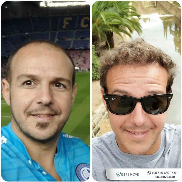 Surgeons Show What A Hair Transplant Can Do With 81 Before And After Pics Surgeons Show What A Hair Transplant Can Do With 81 Before And After Pics