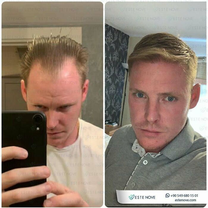 Surgeons Show What A Hair Transplant Can Do With 81 Before And After Pics Surgeons Show What A Hair Transplant Can Do With 81 Before And After Pics