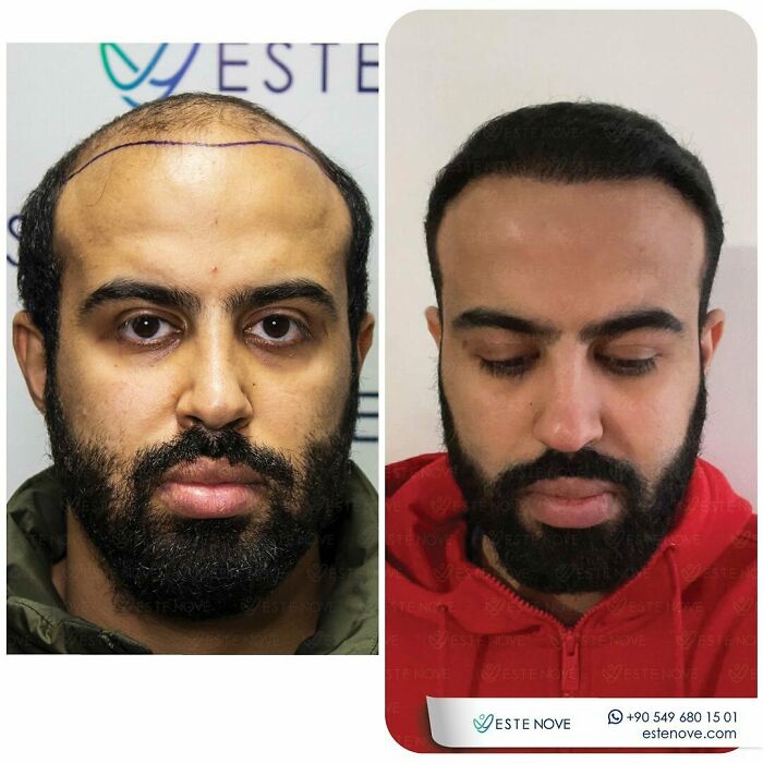 Surgeons Show What A Hair Transplant Can Do With 81 Before And After Pics Surgeons Show What A Hair Transplant Can Do With 81 Before And After Pics
