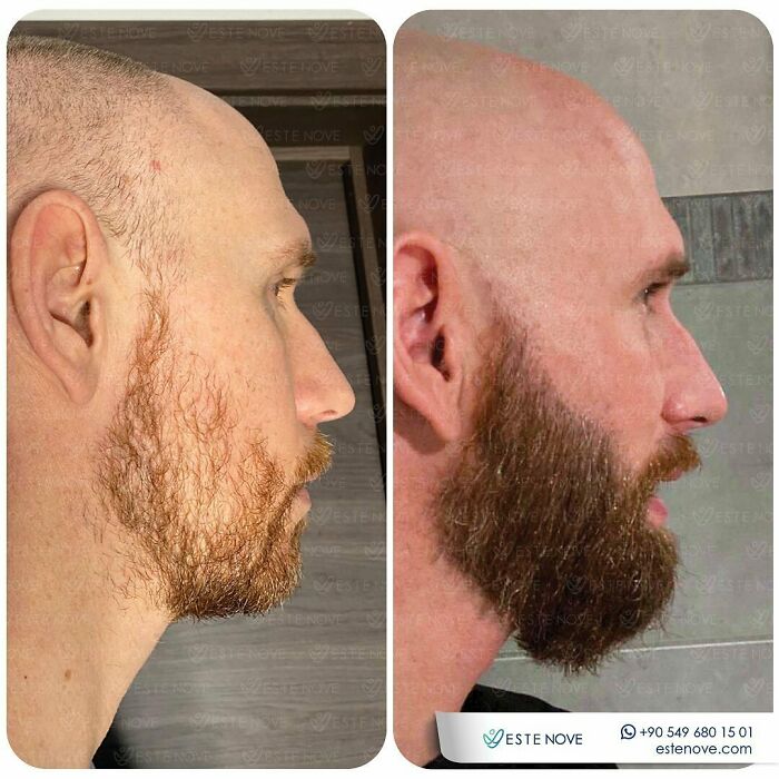 Surgeons Show What A Hair Transplant Can Do With 81 Before And After Pics Surgeons Show What A Hair Transplant Can Do With 81 Before And After Pics