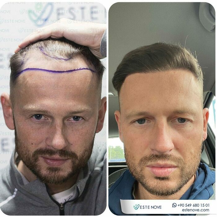 Surgeons Show What A Hair Transplant Can Do With 81 Before And After Pics Surgeons Show What A Hair Transplant Can Do With 81 Before And After Pics