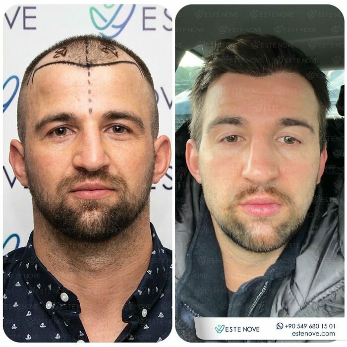 Surgeons Show What A Hair Transplant Can Do With 81 Before And After Pics Surgeons Show What A Hair Transplant Can Do With 81 Before And After Pics