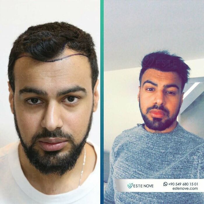 Surgeons Show What A Hair Transplant Can Do With 81 Before And After Pics Surgeons Show What A Hair Transplant Can Do With 81 Before And After Pics