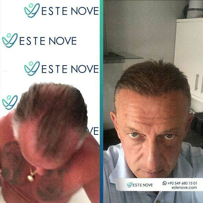 Surgeons Show What A Hair Transplant Can Do With 81 Before And After Pics Surgeons Show What A Hair Transplant Can Do With 81 Before And After Pics