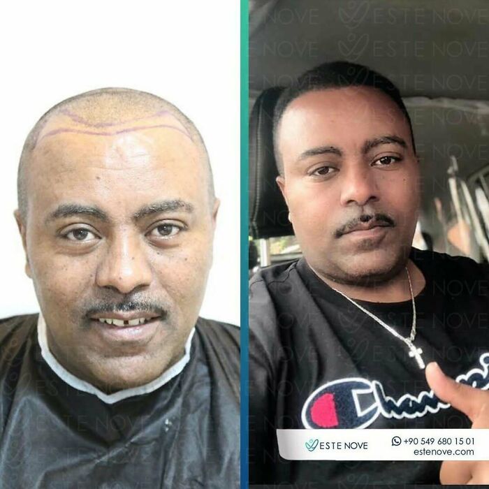 Surgeons Show What A Hair Transplant Can Do With 81 Before And After Pics Surgeons Show What A Hair Transplant Can Do With 81 Before And After Pics