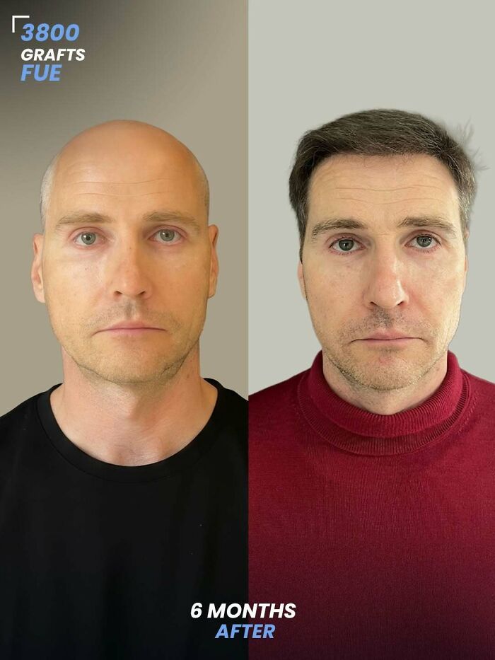 Surgeons Show What A Hair Transplant Can Do With 81 Before And After Pics Surgeons Show What A Hair Transplant Can Do With 81 Before And After Pics