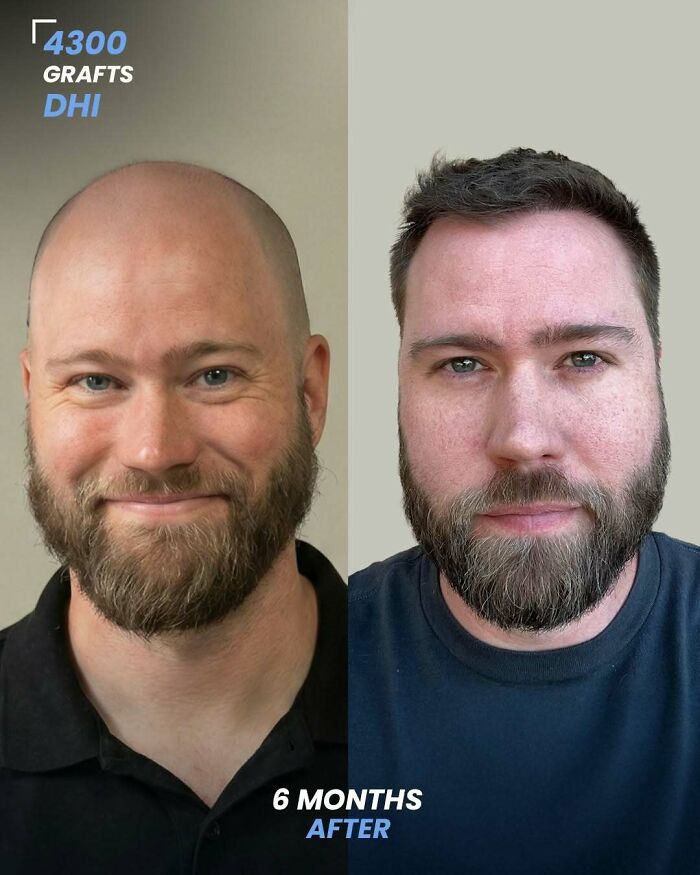 Surgeons Show What A Hair Transplant Can Do With 81 Before And After Pics Surgeons Show What A Hair Transplant Can Do With 81 Before And After Pics