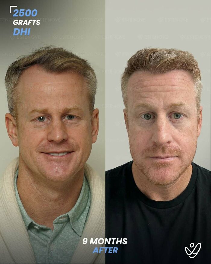 Surgeons Show What A Hair Transplant Can Do With 81 Before And After Pics Surgeons Show What A Hair Transplant Can Do With 81 Before And After Pics