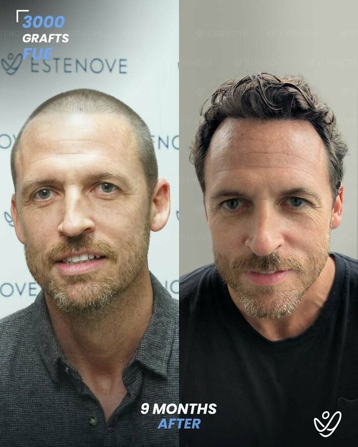 Surgeons Show What A Hair Transplant Can Do With 81 Before And After Pics Surgeons Show What A Hair Transplant Can Do With 81 Before And After Pics