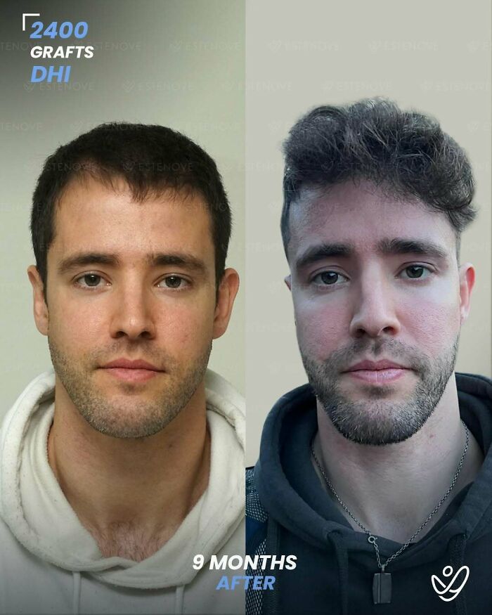 Surgeons Show What A Hair Transplant Can Do With 81 Before And After Pics Surgeons Show What A Hair Transplant Can Do With 81 Before And After Pics