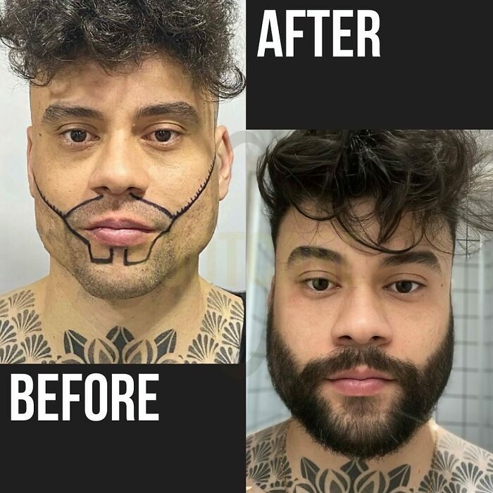 Surgeons Show What A Hair Transplant Can Do With 81 Before And After Pics Surgeons Show What A Hair Transplant Can Do With 81 Before And After Pics