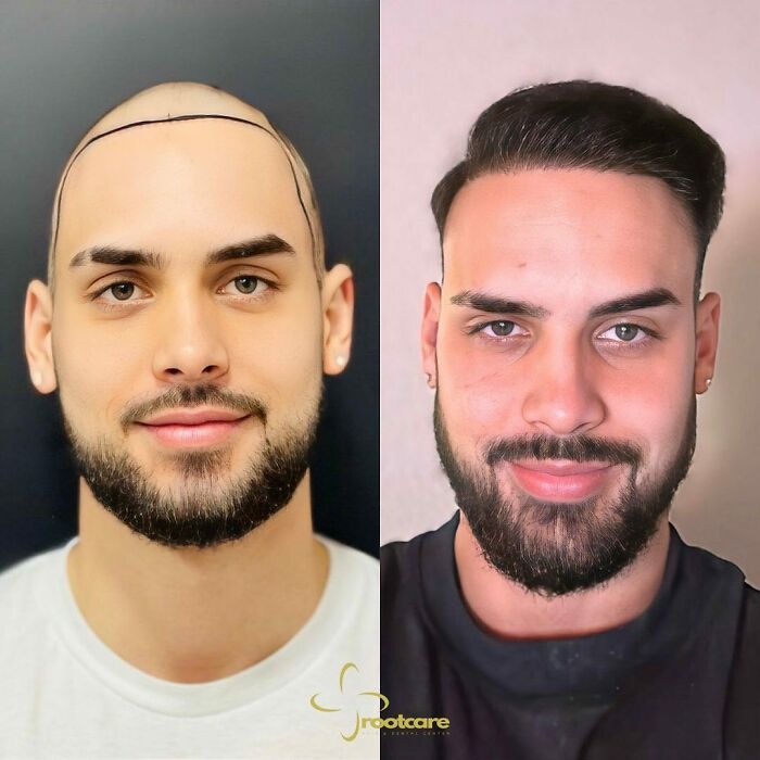Surgeons Show What A Hair Transplant Can Do With 81 Before And After Pics Surgeons Show What A Hair Transplant Can Do With 81 Before And After Pics