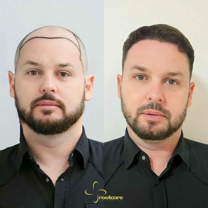 Surgeons Show What A Hair Transplant Can Do With 81 Before And After Pics Surgeons Show What A Hair Transplant Can Do With 81 Before And After Pics