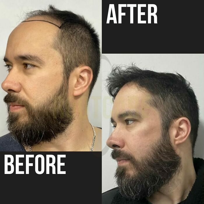 Surgeons Show What A Hair Transplant Can Do With 81 Before And After Pics Surgeons Show What A Hair Transplant Can Do With 81 Before And After Pics