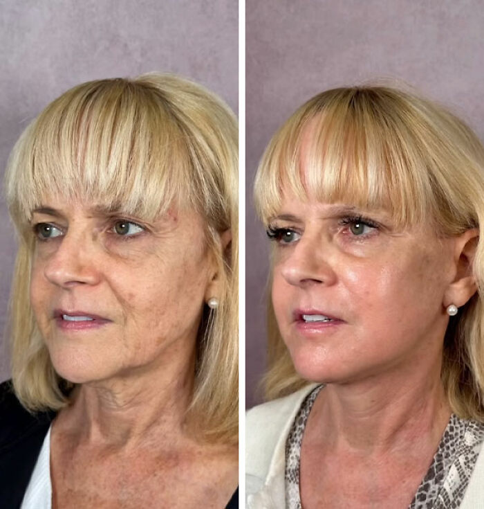 &lsquo;Miracle&rsquo; Plastic Surgeon Goes Viral After Transforming Grandma To Look Decades Younger