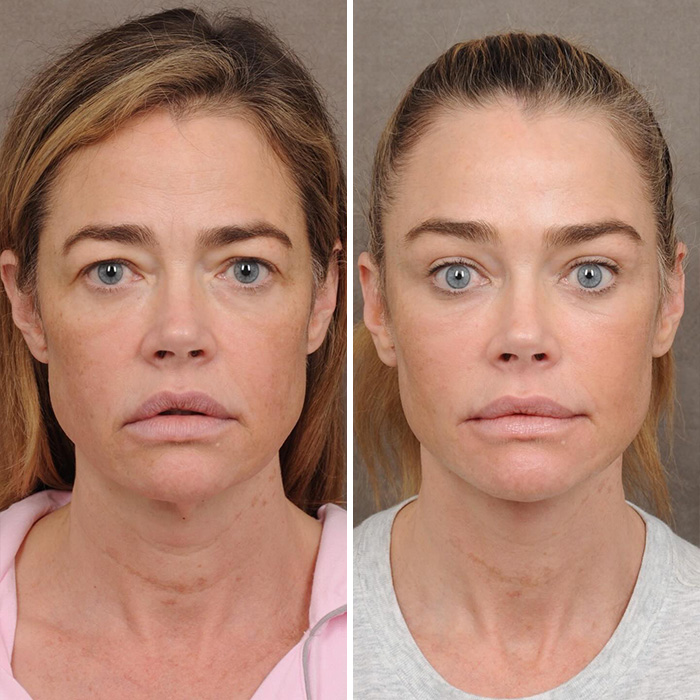 Denise Richards Reveals Dramatic Facelift Transformation In Before-And-After Photos Denise Richards Reveals Dramatic Facelift Transformation In Before-And-After Photos