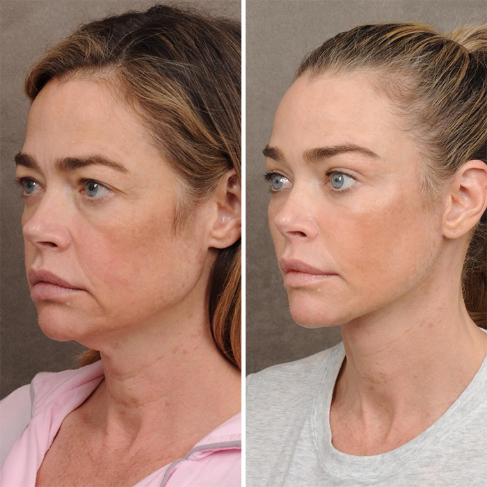 Denise Richards Reveals Dramatic Facelift Transformation In Before-And-After Photos Denise Richards Reveals Dramatic Facelift Transformation In Before-And-After Photos