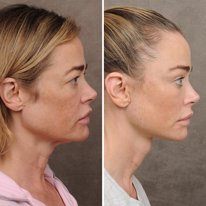 Denise Richards Reveals Dramatic Facelift Transformation In Before-And-After Photos Denise Richards Reveals Dramatic Facelift Transformation In Before-And-After Photos