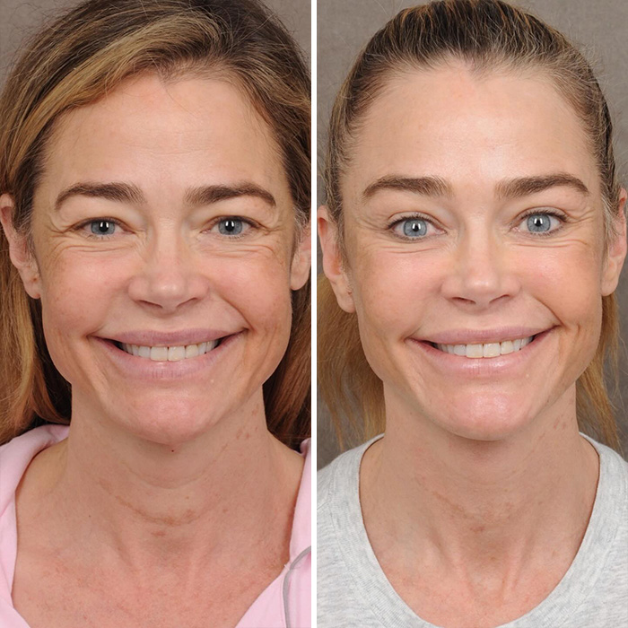 Denise Richards Reveals Dramatic Facelift Transformation In Before-And-After Photos Denise Richards Reveals Dramatic Facelift Transformation In Before-And-After Photos