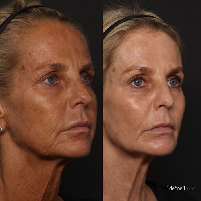 Ulrika Jonsson, 58, Reveals The Six Months Of Treatments Behind Her Dramatic Transformation Ulrika Jonsson, 58, Reveals The Six Months Of Treatments Behind Her Dramatic Transformation